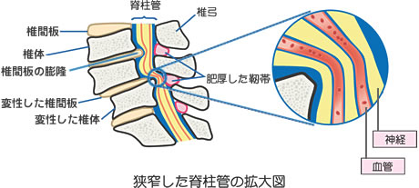 脊柱管狭窄症　画像